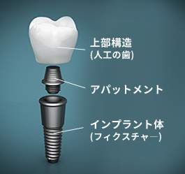 インプラントの構造と種類 | 岐阜 インプラントで口コミ多数・難症例